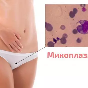 Микоплазмоз – скрытая половая инфекция