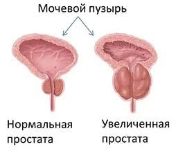 Аденома простаты: виды, диагностика, лечение