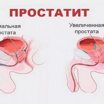 Лечение простатита у мужчин | Лечение хронического простатита на Ленинском